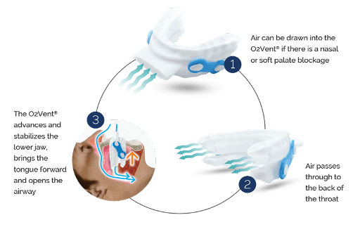 O2VENT Advanced Breathing Care